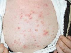 背部和胸部长痘痘可以用火箭队药膏吗 「火箭队药膏能治痘痘吗」