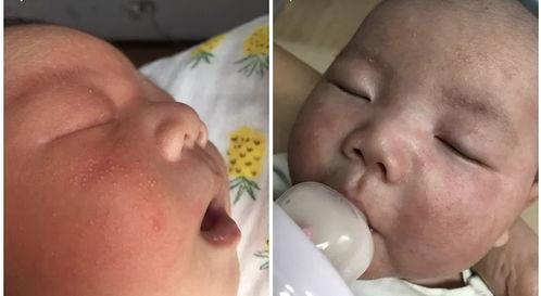 儿子38天了,脸上起了湿疹。买的火箭队儿童乳膏能用吗「火箭队软膏止痒吗」