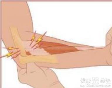 羽毛球姿势网球肘,打羽毛球胳膊疼痛要当心“网球肘”,“网球肘”到底是什么?